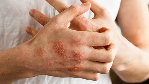 濕疹成因、治療與保養方法